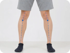 O脚進行例の脚の画像